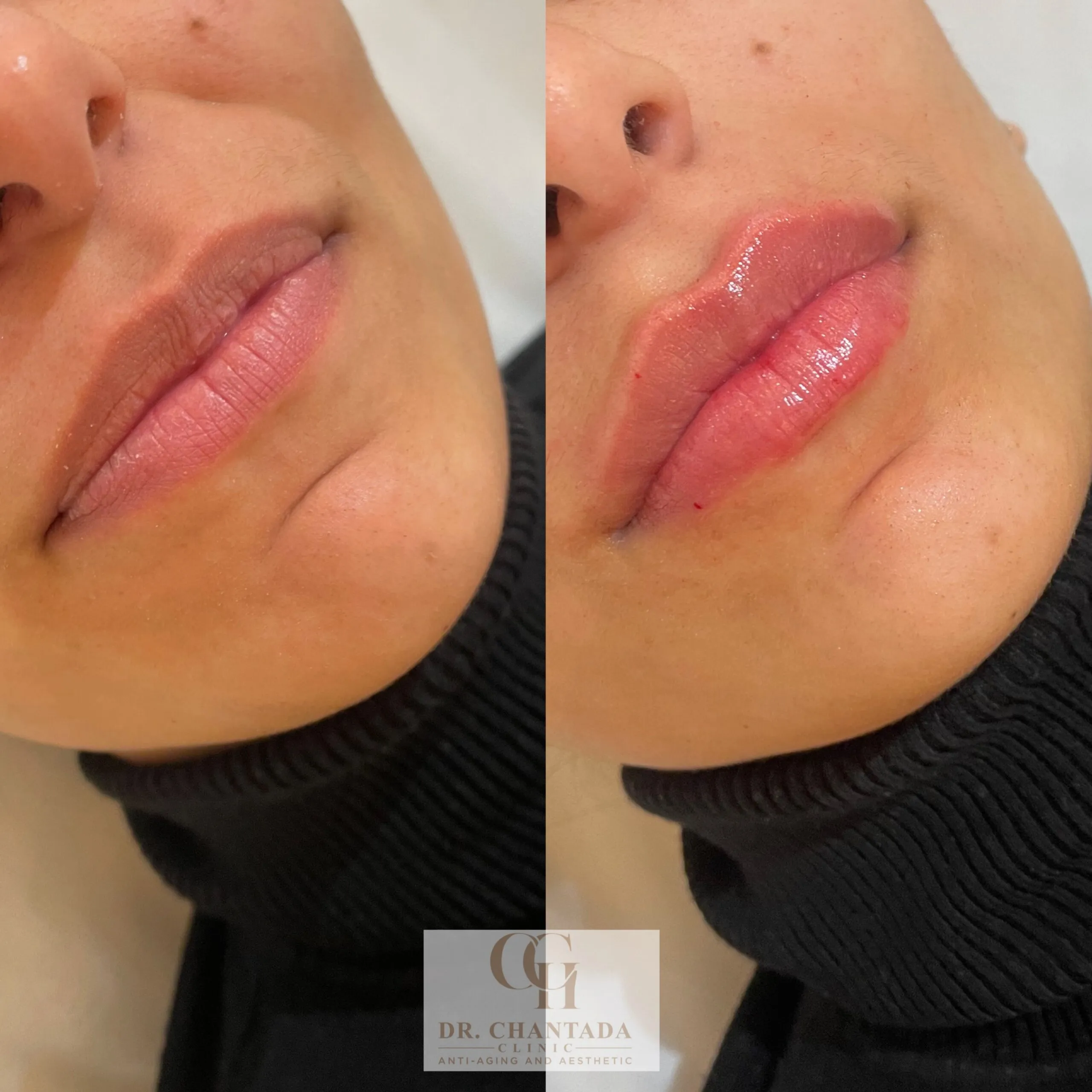 Antes y después — Aumento de labios en Marbella