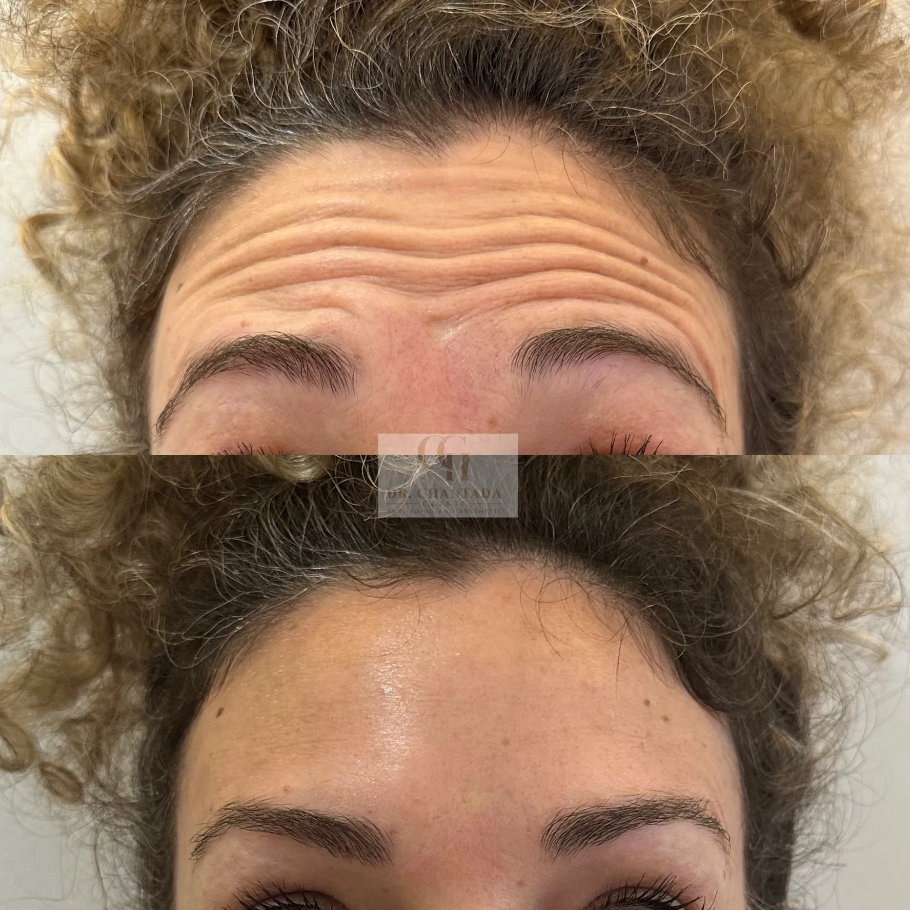 Antes y después — Neuromoduladores en Marbella