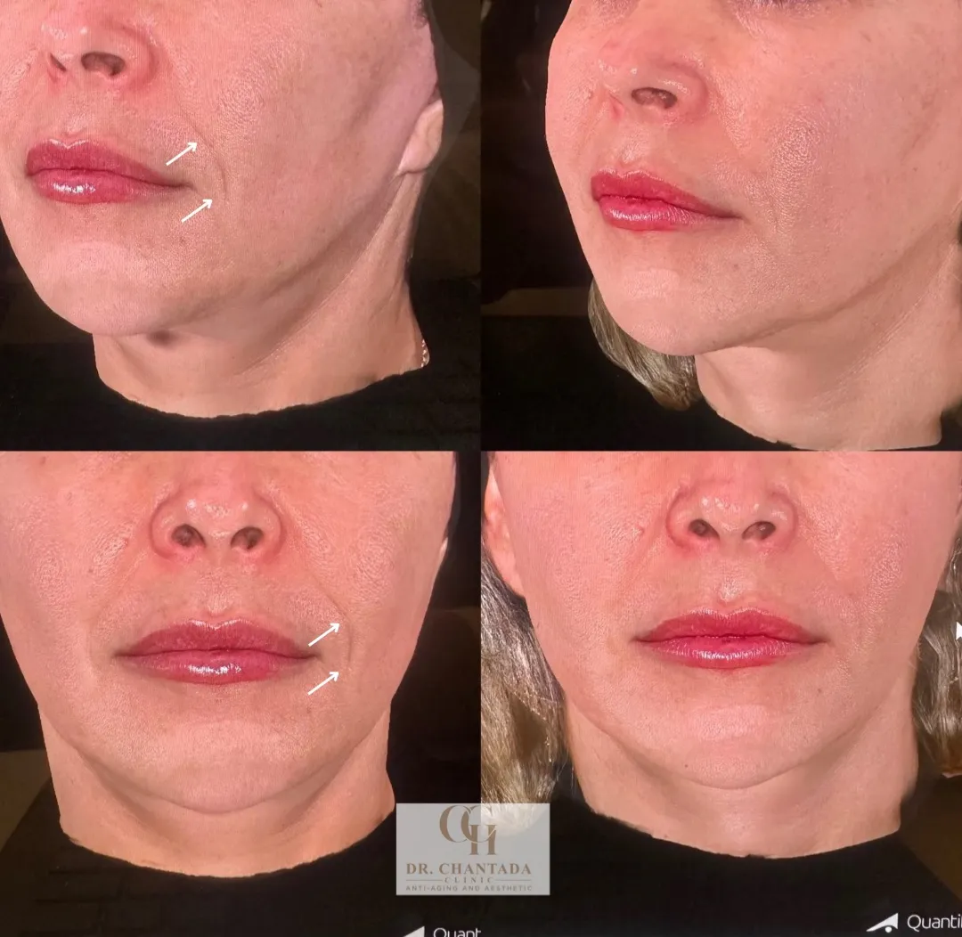 Antes y después — Julaine en Marbella
