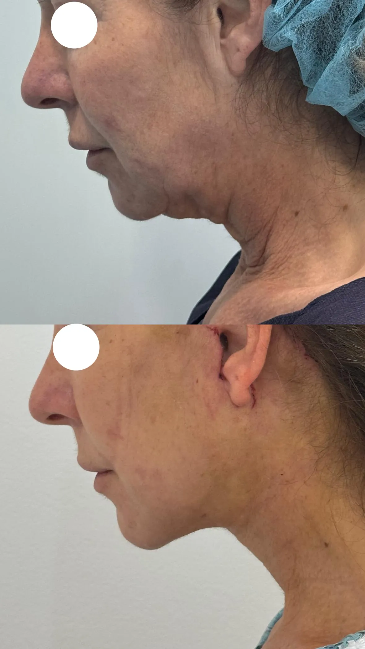 Antes y después — Lifting facial en Marbella