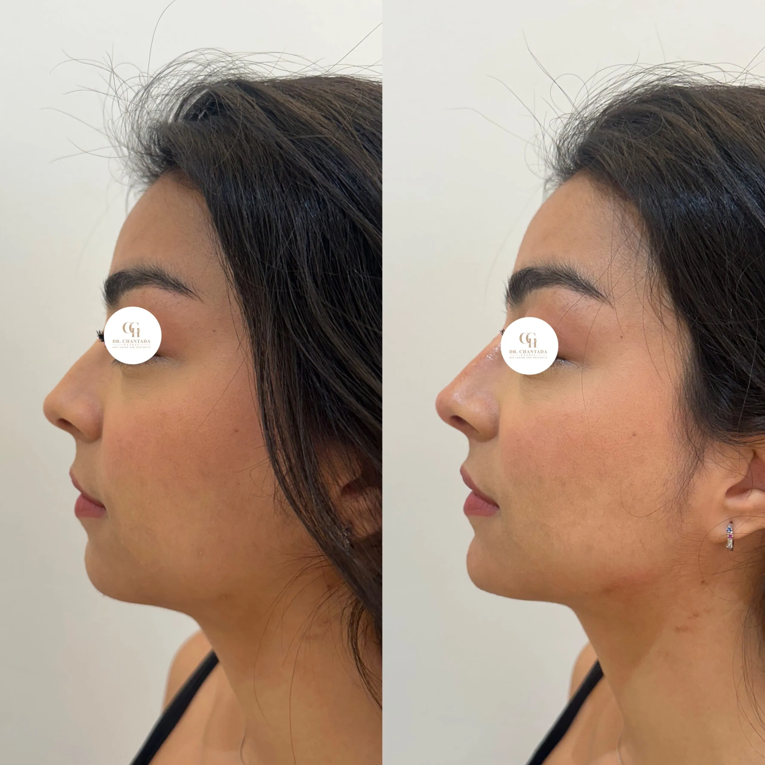 Antes y después — Rinoplastia en Marbella