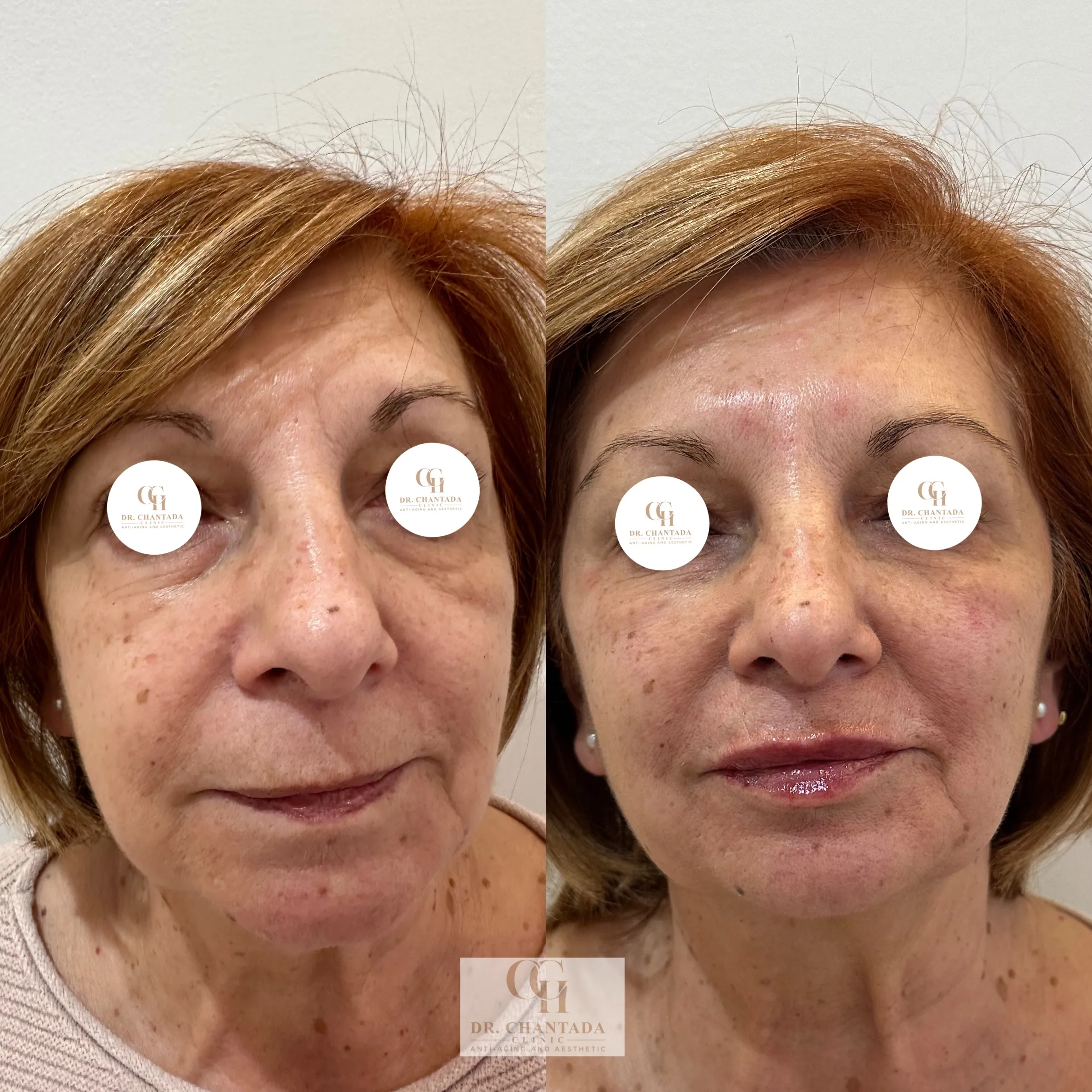 Antes y después — Relleno de pómulos en Marbella