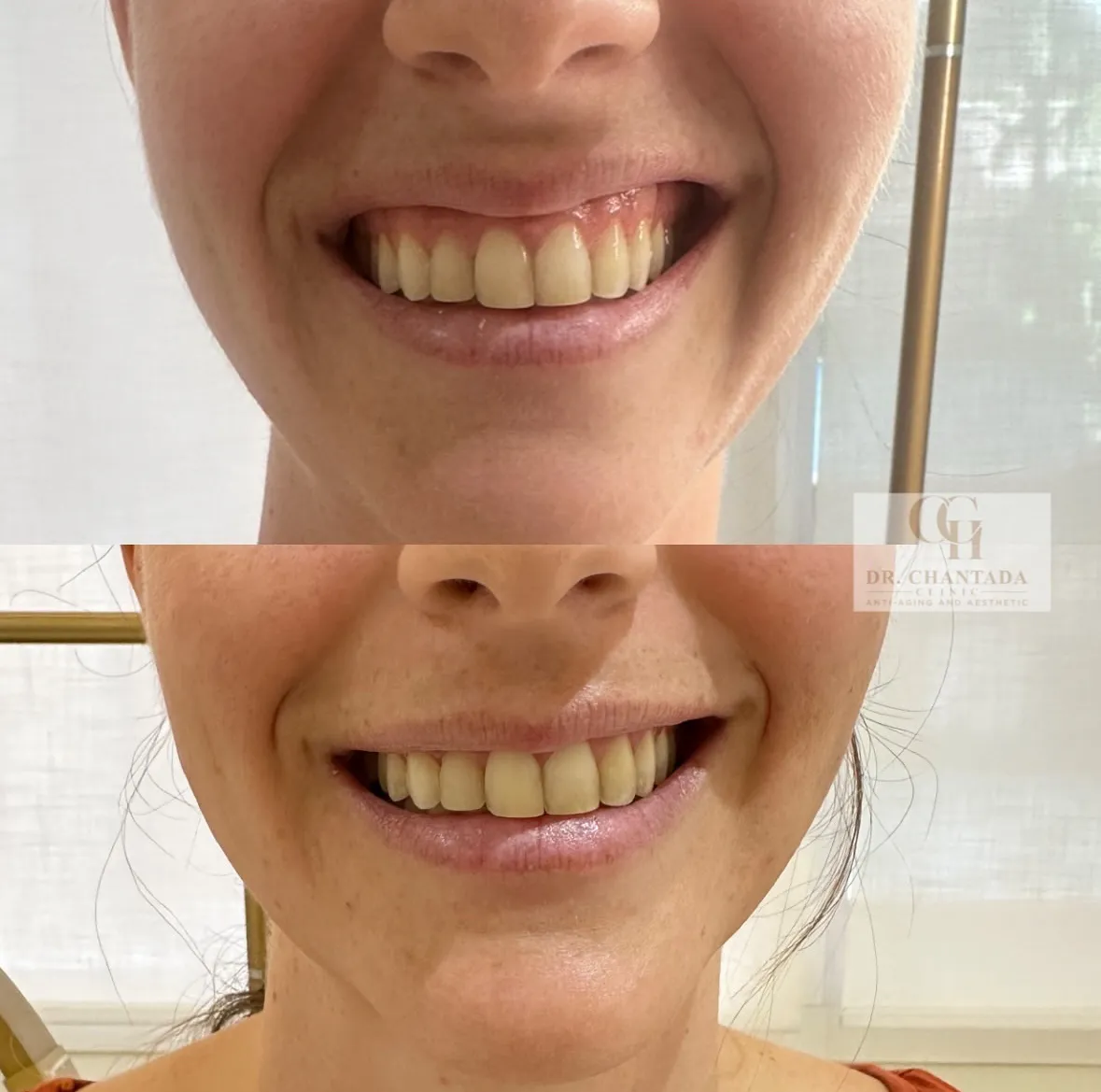 Antes y después — Tratamiento de sonrisa gingival en Marbella