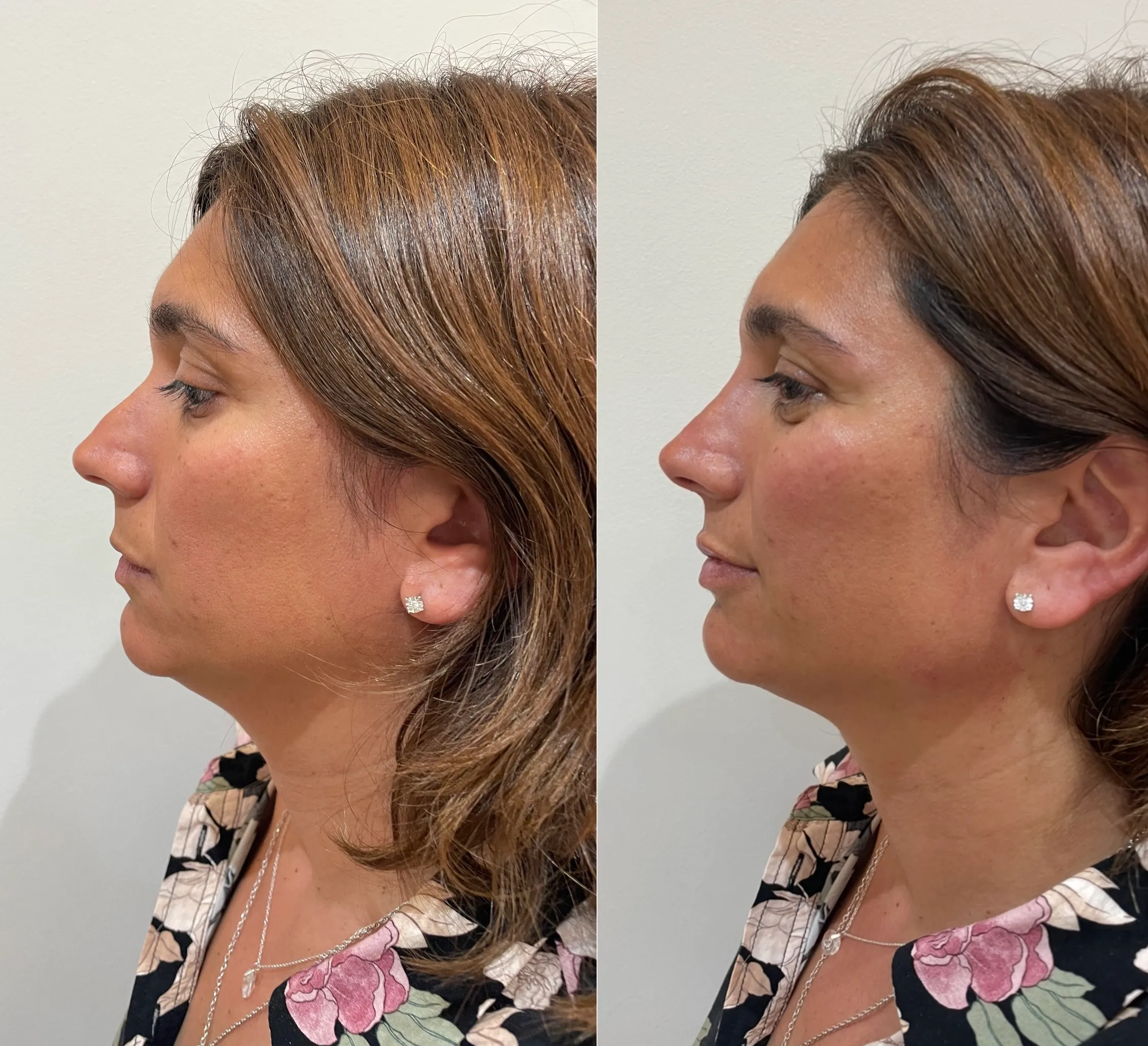 Antes y después — Stimulate en Marbella