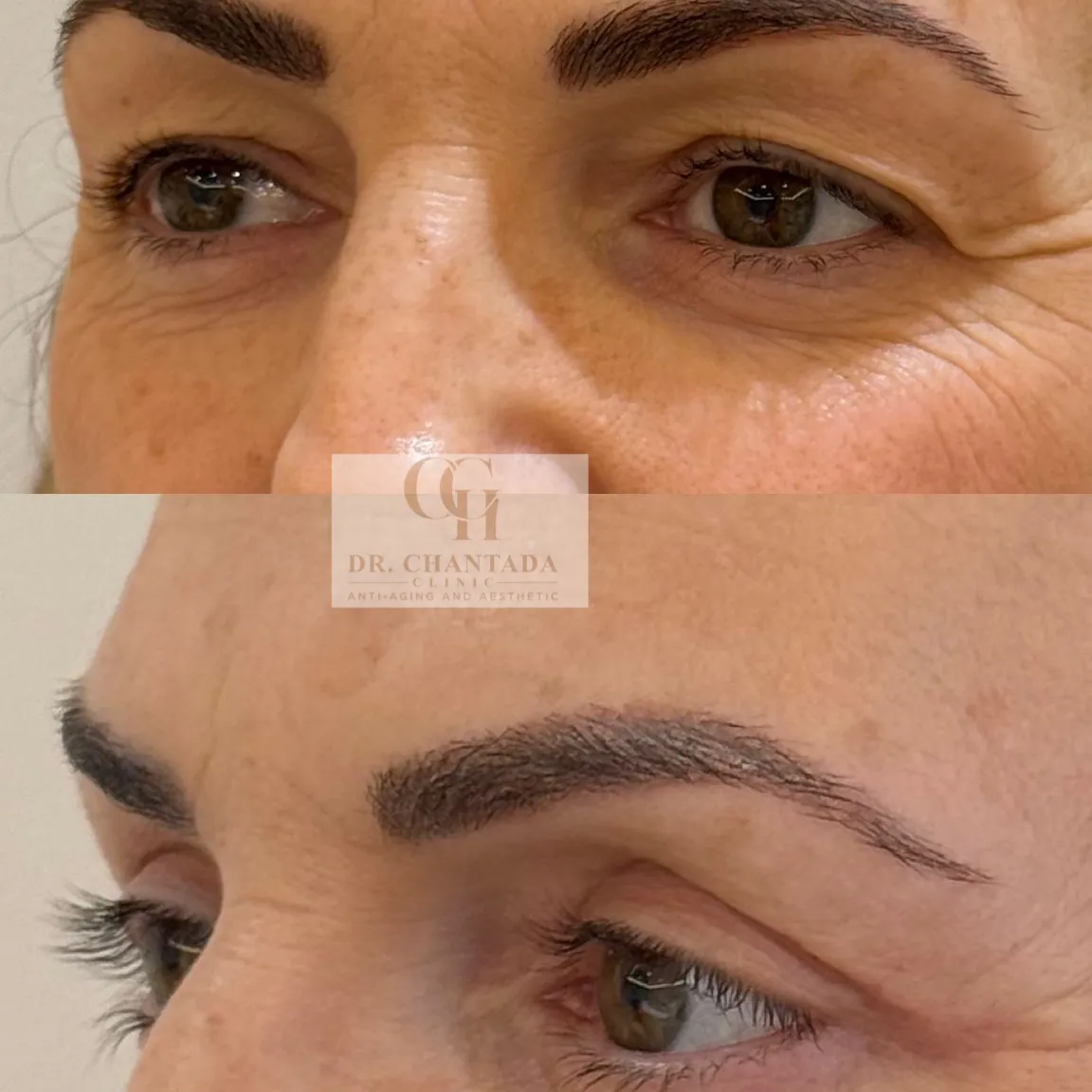 Antes y después — Blefaroplastia inferior en Marbella