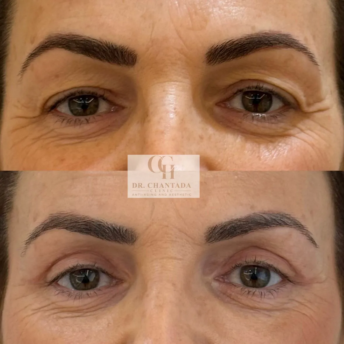 Antes y después — Blefaroplastia en Marbella